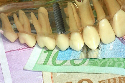Zahnimplantatkosten