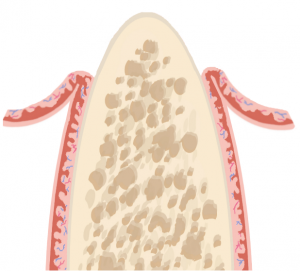 Grafische Darstellung einer Spreizung des Kieferknochens Schritt 1 Zahnfleisch wurde eröffnet