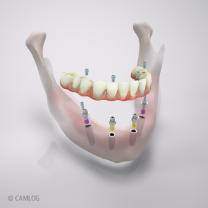 Zahnlosen UK mit fester Brücke auf 4 Implantaten