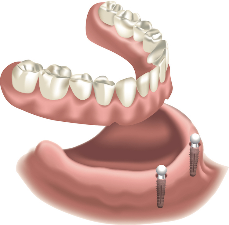 Zahnloser Unterkiefer mit 2 Kugelkopfimplantaten und Vollprothese