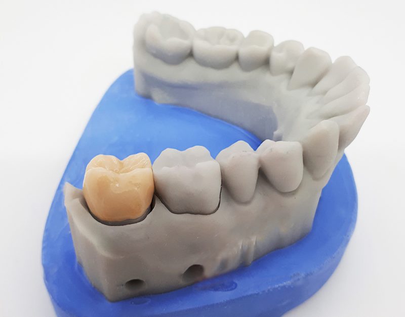 Zahnerhalt in der modernen Zahnheilkunde: Zahnkronen & Teilkronen