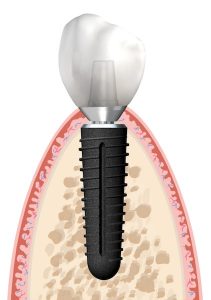 Grafik Implantat mit Krone im Knochen